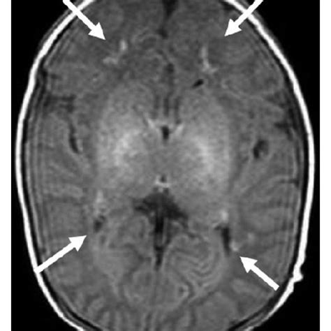 Clinical Features of MEN2B syndrome. Note (a) the laxity in the first ...