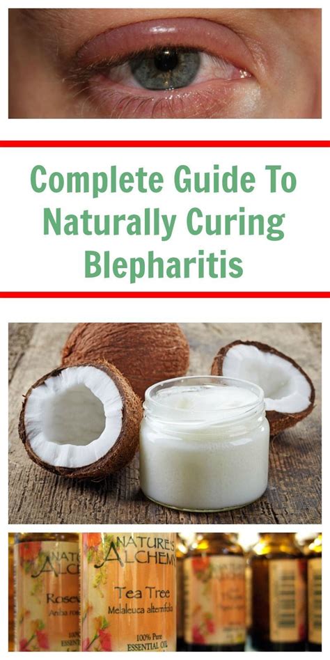 Complete Guide To Naturally Curing Blepharitis Blepharitis Essential