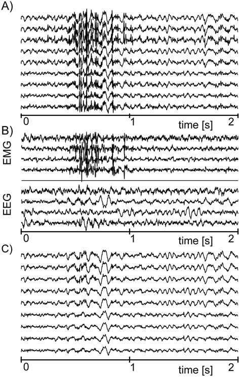 An Example Of Muscular Artifact Suppression Using The ICA A The