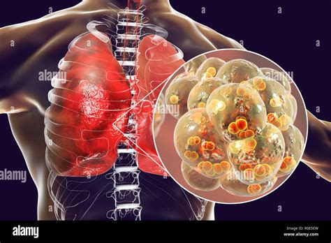 Pneumococcal Pneumonia Computer Illustration Of Streptococcus