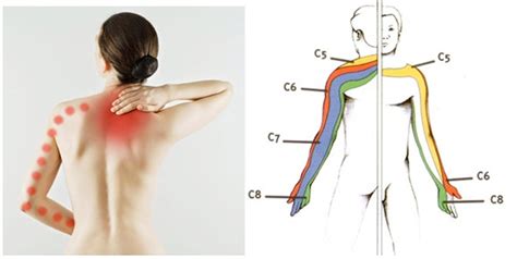 L Tiopathie Pour Soigner La N Vralgie Cervico Brachiale Th Ragora Hot