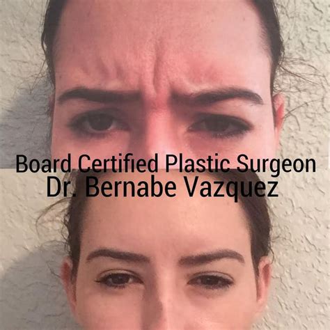 All Injections Are Done By Board Certified Plastic Surgeon Dr Bernabe