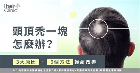 撥頭髮頭皮痛是什麼原因3個可能全面分析 Ihair風華御髮