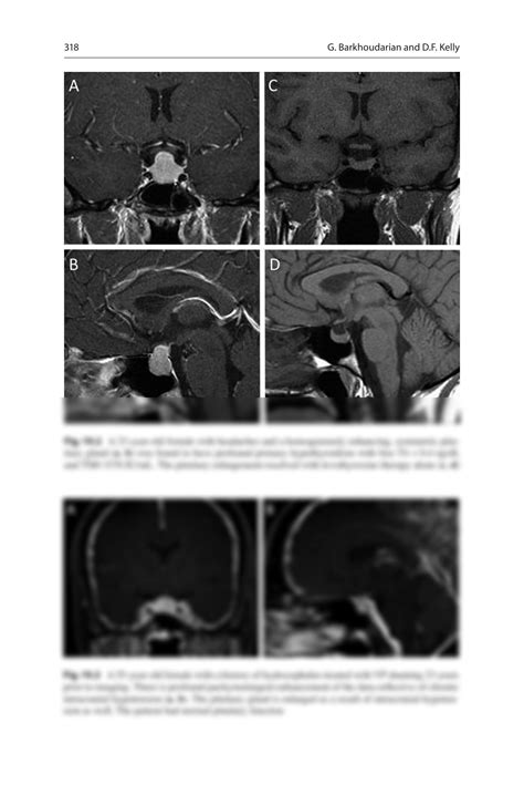 SOLUTION: Complications with transsphenoidal surgery a review - Studypool