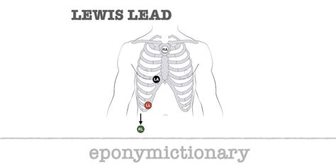 Lewis lead • LITFL • Medical Eponym Library