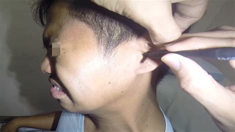 Watch How To Remove Man S Dry Earwax YouTube