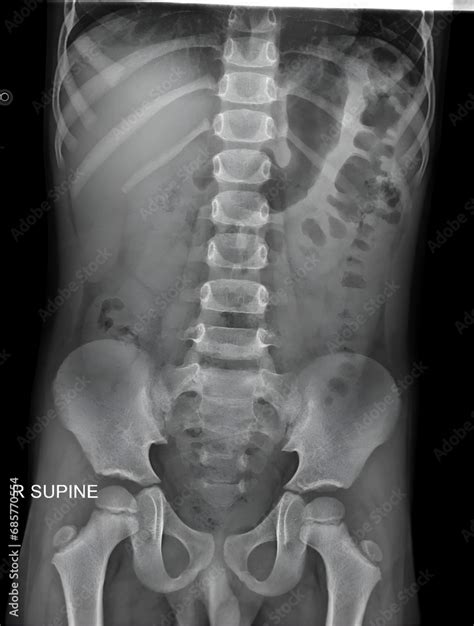 This Pediatric Abdominal And Pelvic X Ray Provides A Comprehensive View