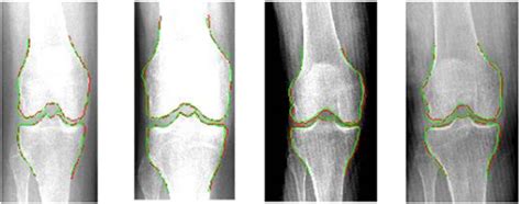 Construction Of 3D Model Of Knee Joint Motion Based On MRI Image