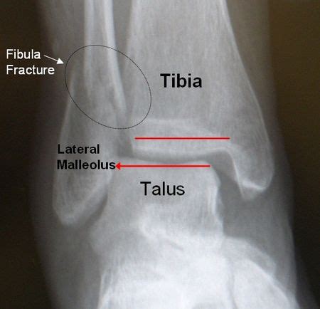 Fibular Fracture - Physiopedia