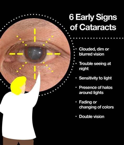 Cataracts Symptoms