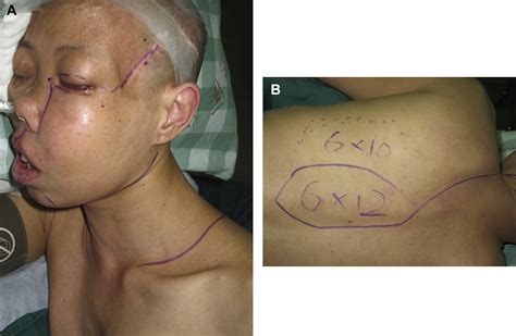 Craniofacial Resection And Reconstruction In Patients With Recurrent