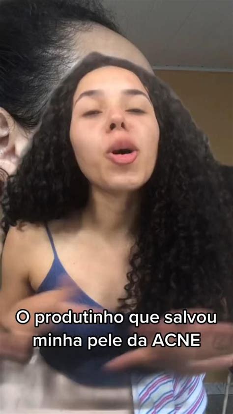 O Produto Que Salvou Minha Pele Da Acne V Deo Em Acne Gel