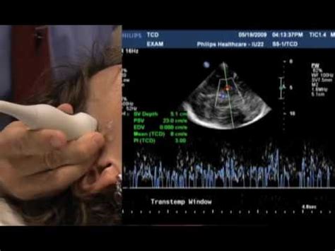 Transcranial Doppler Ultrasound Anatomy