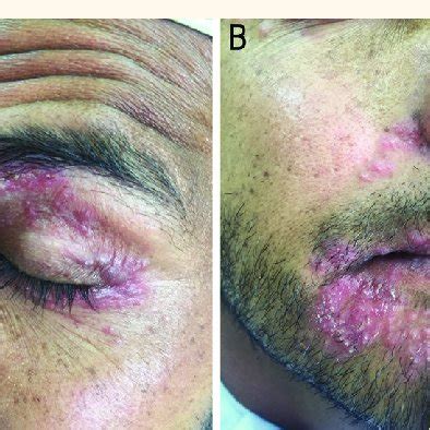 Differential diagnosis of granulomatous papules on the face 11,13-17 | Download Scientific Diagram