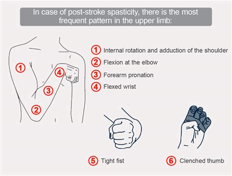 Upper Limb Spasticity