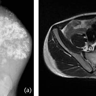 (a) X-ray of secondary chondrosarcoma developing in a prior ...