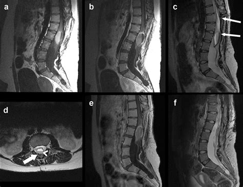 Magnetic resonance imaging (MRI) of the lumbosacral spinal cord. a ...