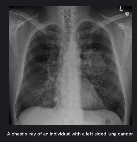 Lung Cancer Flashcards Quizlet