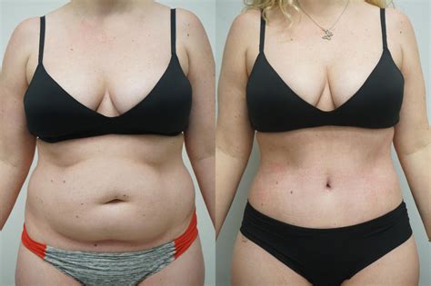 Abdominoplastie Tunisie Meilleur Chirurgien Chirurgie Ventre Prix