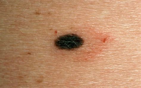 Moles Causes Types Abnormal Cancerous Moles