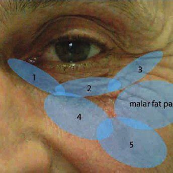 Long standing edema of the lower lid and malar bag | Download ...