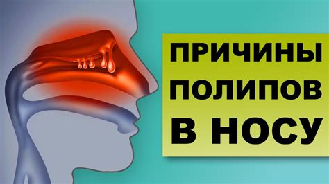 Полипы в носу: симптомы и лечение медикаментозное, как понять по признакам