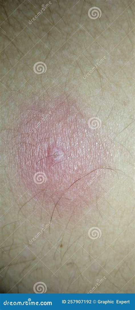 Wound Infection on Body Skin Stock Photo - Image of body, women: 257907192