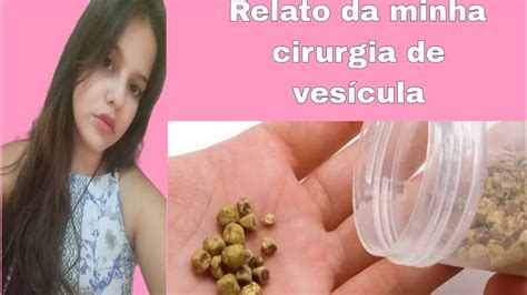 Cirurgia De Ves Cula Pelo Sus Meu Relato Recupera O Youtube