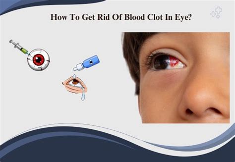 how to get rid of blood clot in eye