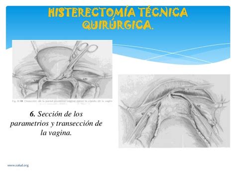 Cirugias Ginecologicas