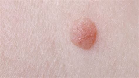 Warts vs. Skin Cancer | Can a Wart Be Skin Cancer?