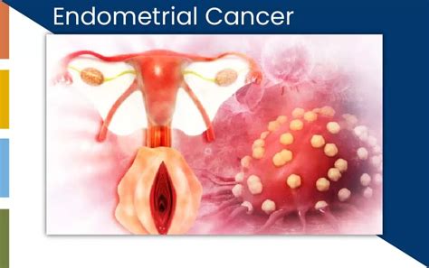 Endometrial Cancer - Orkid Medilife Hospital