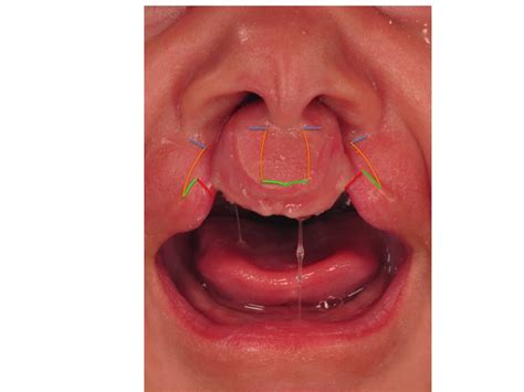 Bilateral Cleft Lip And Palate Dallas Plastic Surgeon Specializing In