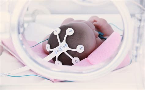 Webinar Alternate Solution To Needle Electrodes For Neonatal AEEG EEG