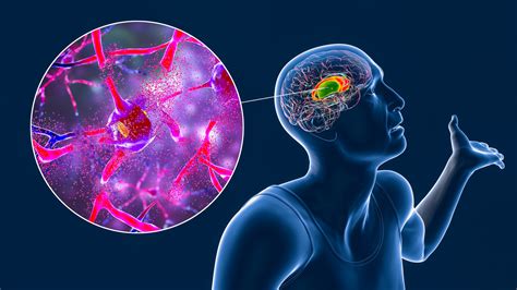 Malattia di Huntington • +Plus! Magazine