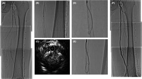 Angiographic Images And An Intravascular Ultrasound Ivus Image