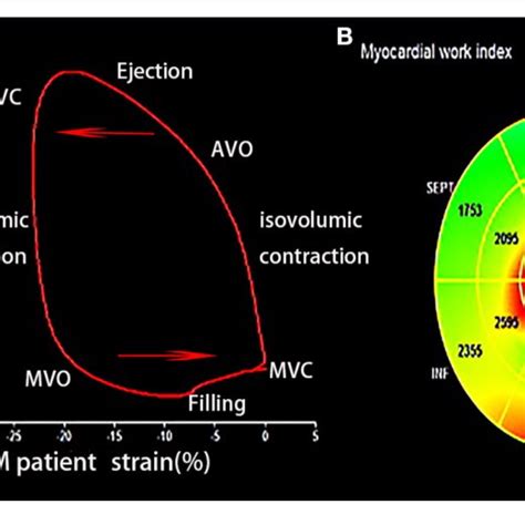 A Left Ventricular Lv Pressure Strain Loops Of Patient With Mm Download Scientific