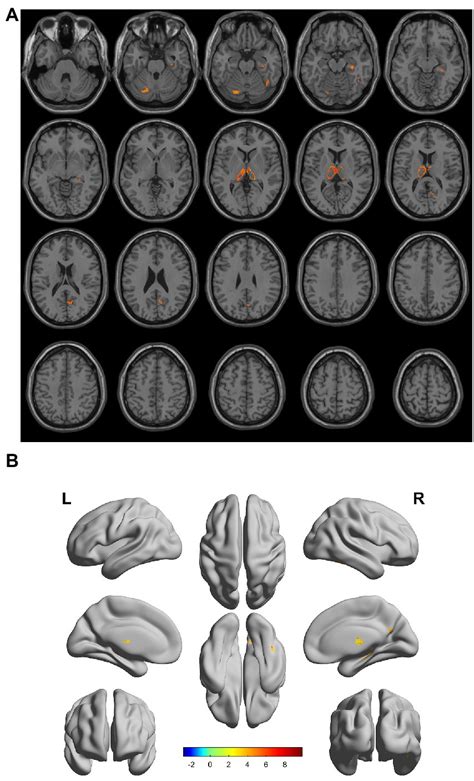 Frontiers Study Of Gray Matter Atrophy Pattern With Subcortical