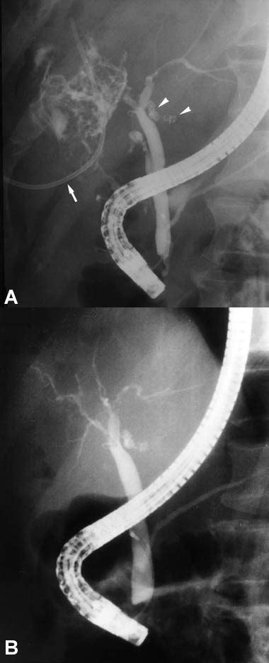 Endoscopic Biliary Stenting For Treatment Of Persistent Biliary Fistula