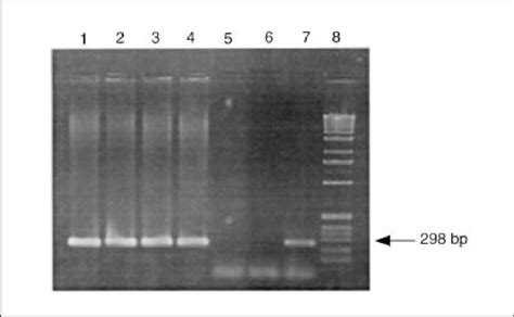 Agarose Gel Of Amplification Products From A β β Globin Pcr The