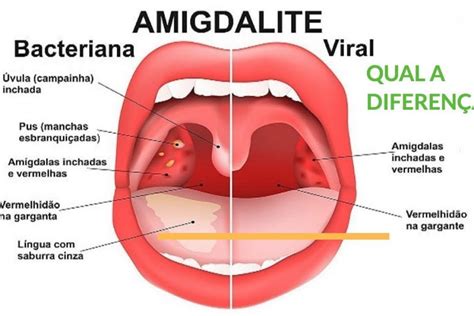 AMIGDALITE VIRAL O QUE É E COMO TRATAR