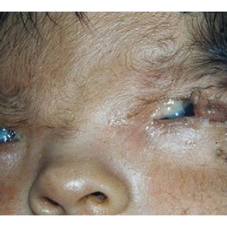 (PDF) Congenital Upper Eyelid Coloboma: Clinical and Surgical Management