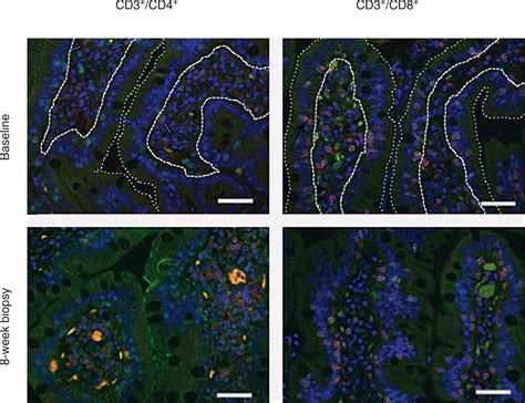 Oral Serum Derived Bovine Immunoglobulin Improves Duodenal I Aids