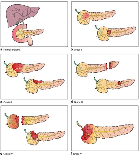 Pancreas Injury The Good The Bad And The Ugly Injury