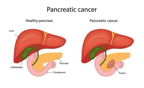 Pancreatic Cancer Diagnosis And Treatment Health Guide 2022