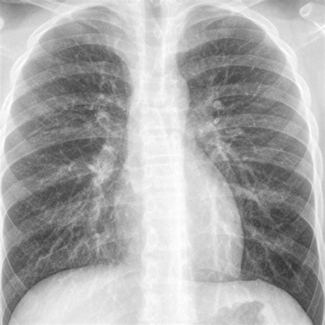 Pneumonia Chest X Ray Findings