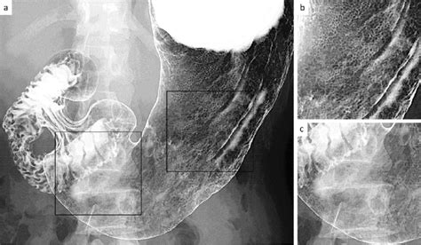 Figure Double Contrast Upper Gastrointestinal Barium X Ray Radiography