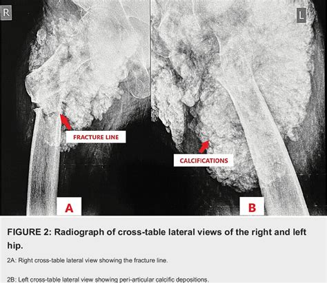 Figure 2 From A Rare Case Of Bilateral Hip Tumoral Calcinosis With