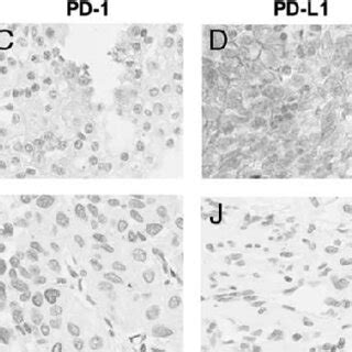 A Representative Case No 1 A Patient With PD 1 CTLA 4 And LAG 3