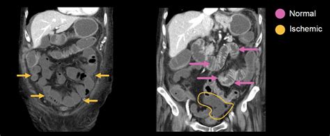 Abdominal CT Phases LITFL Radiology Library